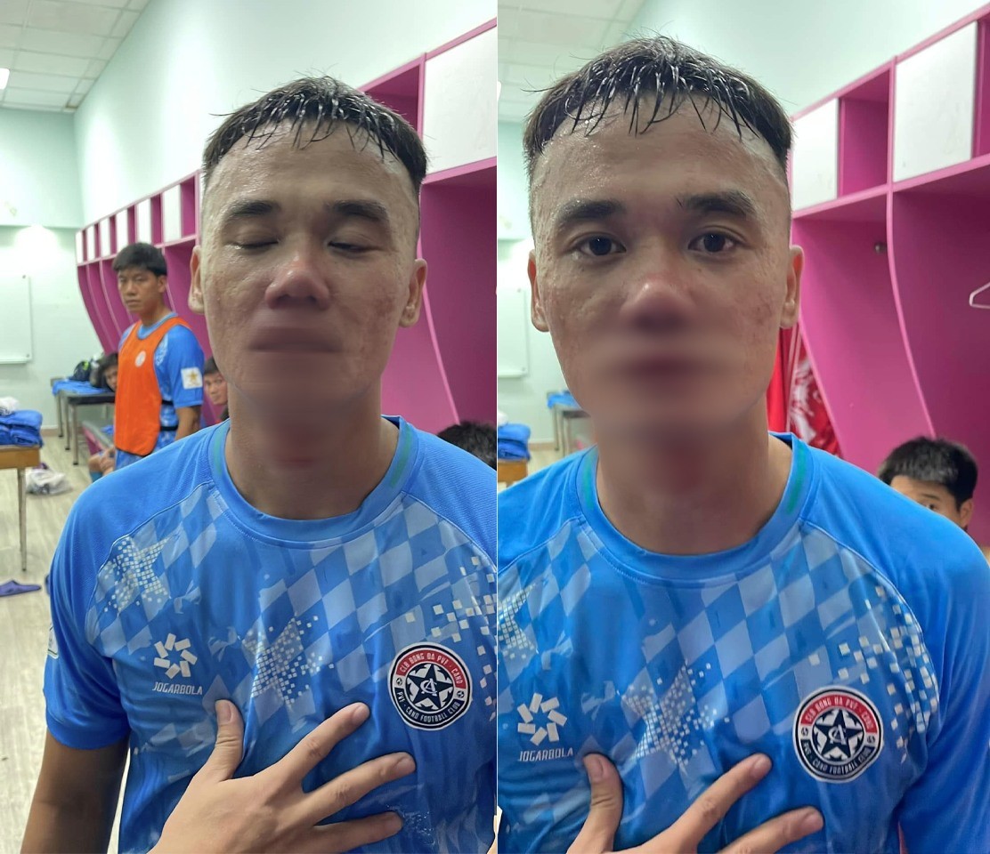 Toàn cảnh vụ cựu tiền đạo tuyển Việt Nam bị đối thủ đấm vỡ mũi